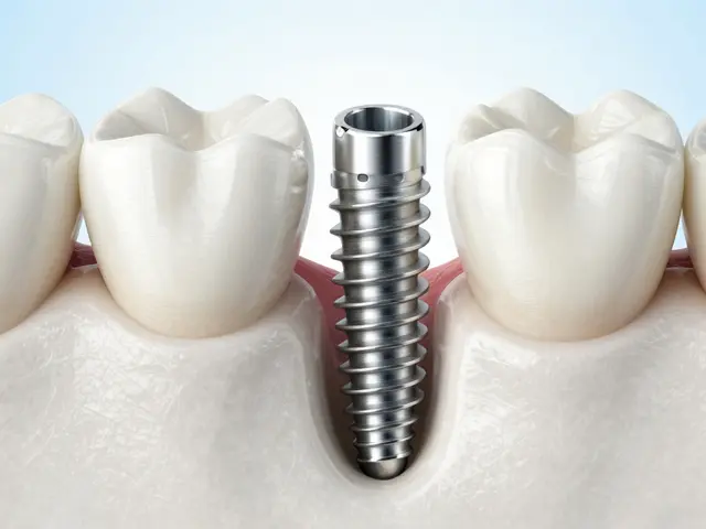 Jak zubní implantáty zlepšují život po léčbě bruxismu: Kompletní průvodce