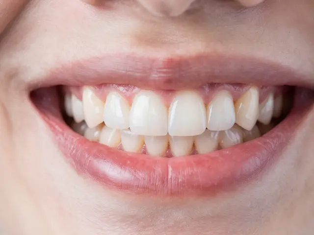 Nejlepší zubní náhrady pro prevenci mezizubního kazu: Kompletní průvodce